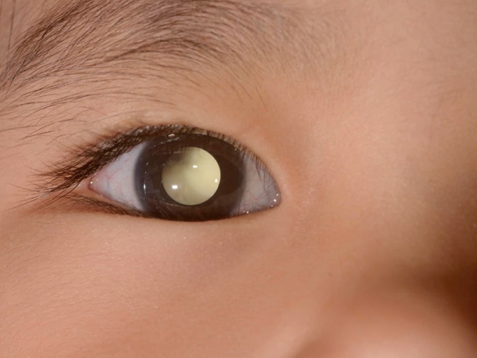 Retinoblastoma: o câncer de olho mais frequente nas crianças